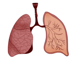 cancer mesotelioma pleural
