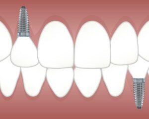 implante dental