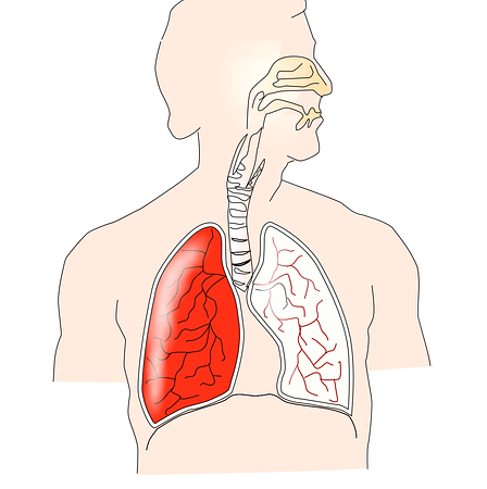 pulmonía