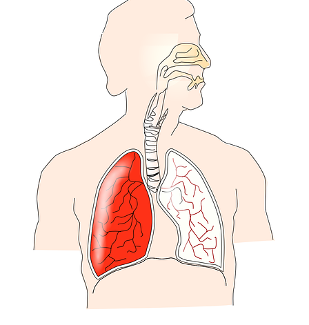 pulmonía