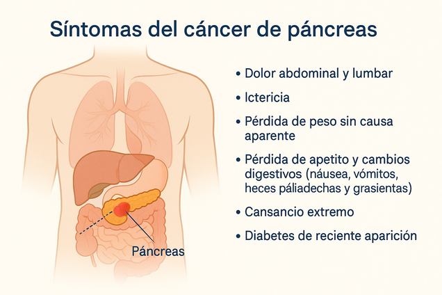 síntomas del cáncer de páncreas