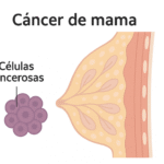 Cáncer de Seno